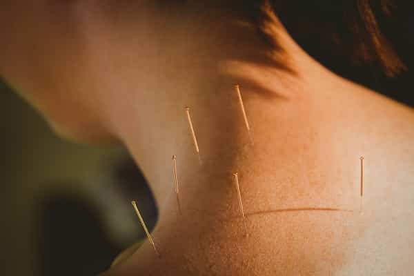 Acupuncture