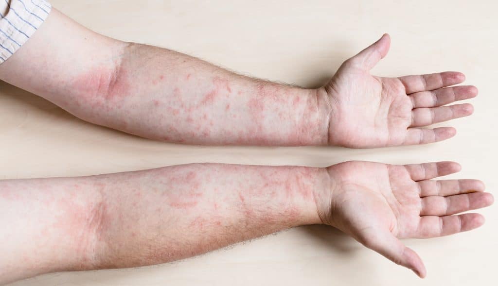 Lichen Planus